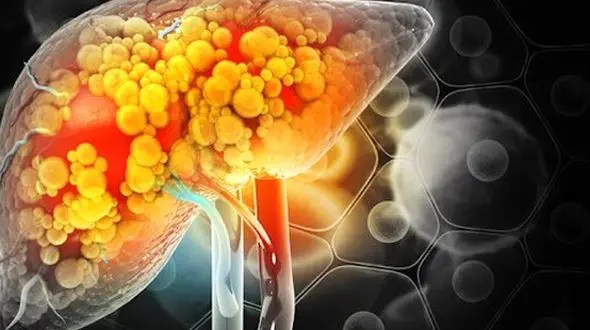 گریدهای مختلف کبد چرب / علائم و روش‌ های شناسایی