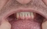  استان های کرمان و سیستان و بلوچستان؛ رکورددار ابتلا به سرطان دهان در ایران / مرگ 180 هزار نفر در جهان به علت ابتلا به سرطان دهان! 