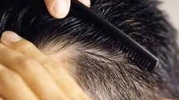 گامی نوین در درمان ریزش مو