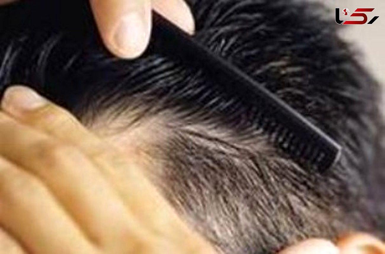 گامی نوین در درمان ریزش مو
