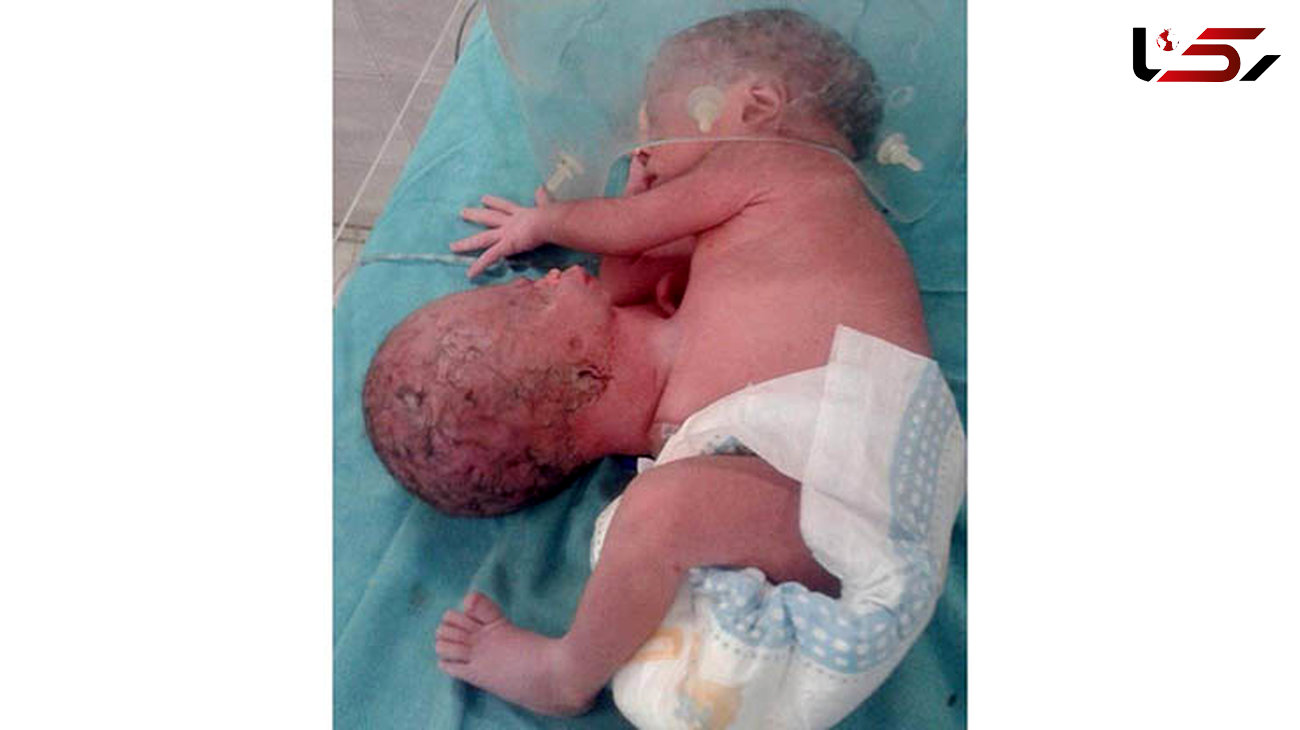تولد نوزادی که روی شکم خود یک سر اضافی دارد+ عکس