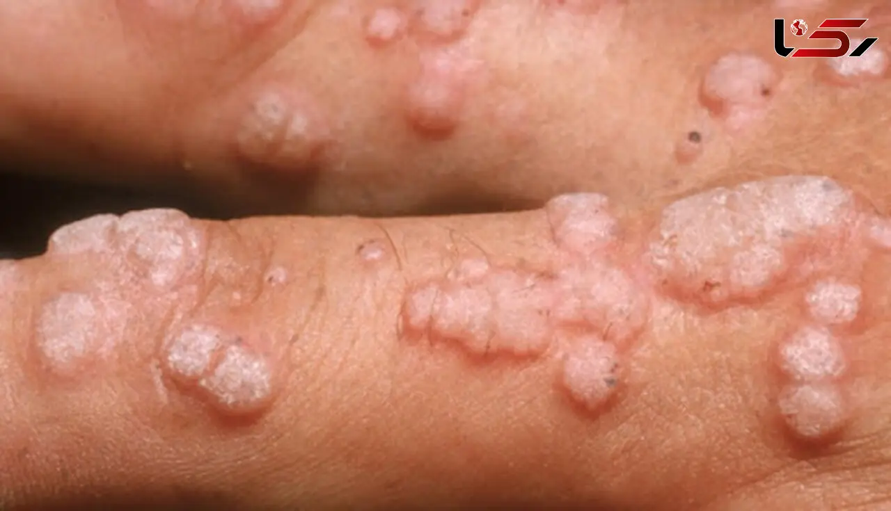 حرکت موج  hpv در ایران / مرگ سالانه 300 هزار زن / مسئولان هرچه زودتر واکسن در دسترس قرار دهند
