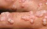 حرکت موج  hpv در ایران / مرگ سالانه 300 هزار زن / مسئولان هرچه زودتر واکسن در دسترس قرار دهند