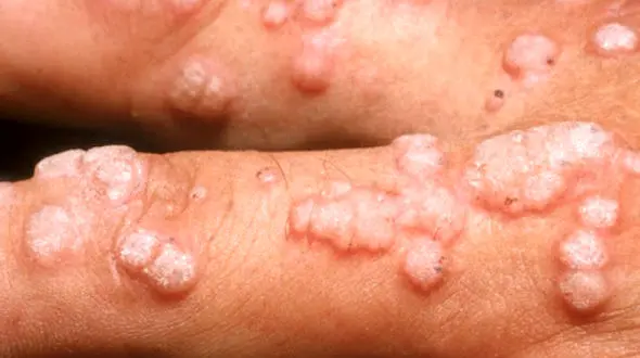 حرکت موج  hpv در ایران / مرگ سالانه 300 هزار زن / مسئولان هرچه زودتر واکسن در دسترس قرار دهند