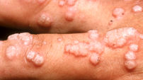 حرکت موج  hpv در ایران / مرگ سالانه 300 هزار زن / مسئولان هرچه زودتر واکسن در دسترس قرار دهند