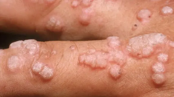 حرکت موج  hpv در ایران / مرگ سالانه 300 هزار زن / مسئولان هرچه زودتر واکسن در دسترس قرار دهند