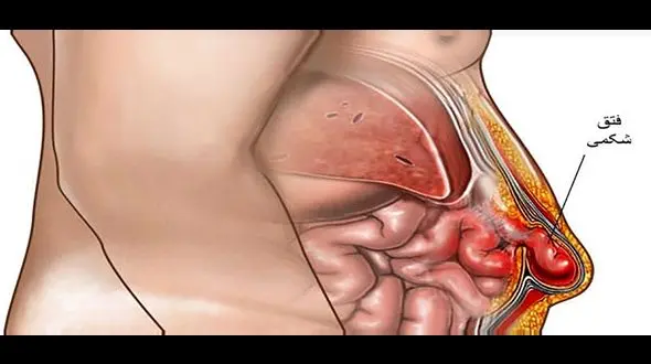 عمل فتق چیست؟ / جدول انواع فتق، مزایا و معایب عمل فتق + باید و نبایدهای دوران نقاهت بعد از عمل فتق