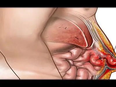 عمل فتق چیست؟ / جدول انواع فتق، مزایا و معایب عمل فتق + باید و نبایدهای دوران نقاهت بعد از عمل فتق