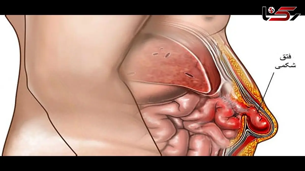 عمل فتق چیست؟ / جدول انواع فتق، مزایا و معایب عمل فتق + باید و نبایدهای دوران نقاهت بعد از عمل فتق