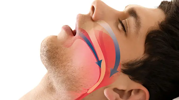 آپنه خواب چیست؟