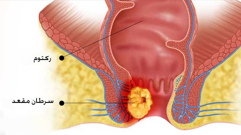 درد مقعد
