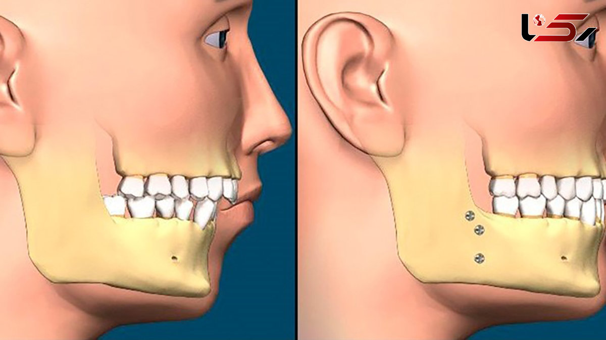 آیا جراحی فک باعث مرگ می شود؟ / رعایت بهداشت دهان و دندان پس از جراحی فک را جدی بگیرید