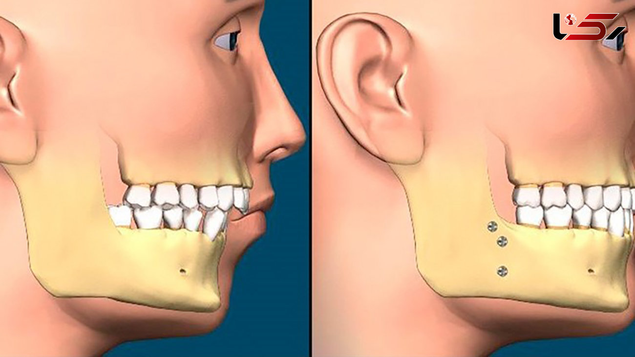 آیا جراحی فک باعث مرگ می شود؟ / رعایت بهداشت دهان و دندان پس از جراحی فک را جدی بگیرید