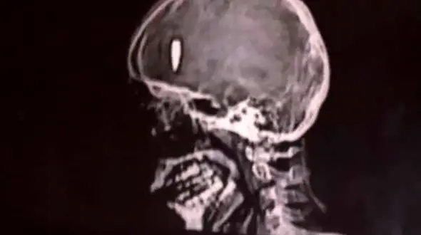 نجات معجزه آسا / گلوله در جمجمه پسر خوزستانی گیر کرد + عکس