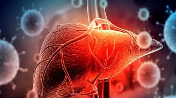 آیا سرطان کبد به قاتل 1/5 میلیون نفر تا سال 2050 تبدیل می‌ شود؟