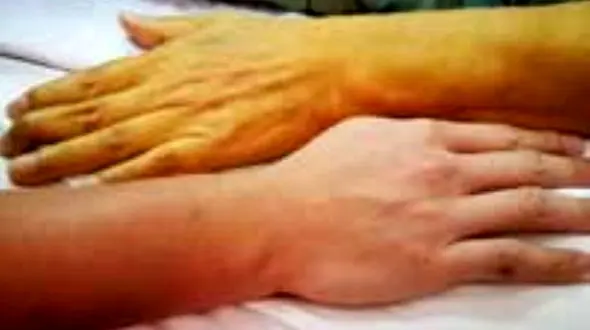 خطر یرقان با مصرف داروهای گیاهی ناشناخته 