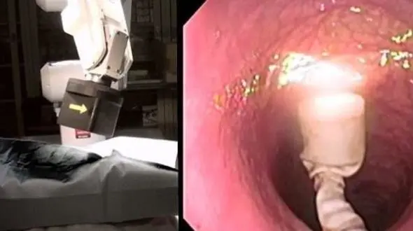 خطرات کولونوسکوپی و تحریک  آپاندیسیت