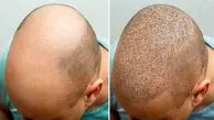 کاشت مو به روش میکروفیت و میکروگرافت دستیابی به تراکم طبیعی و خط رویش بی‌نقص