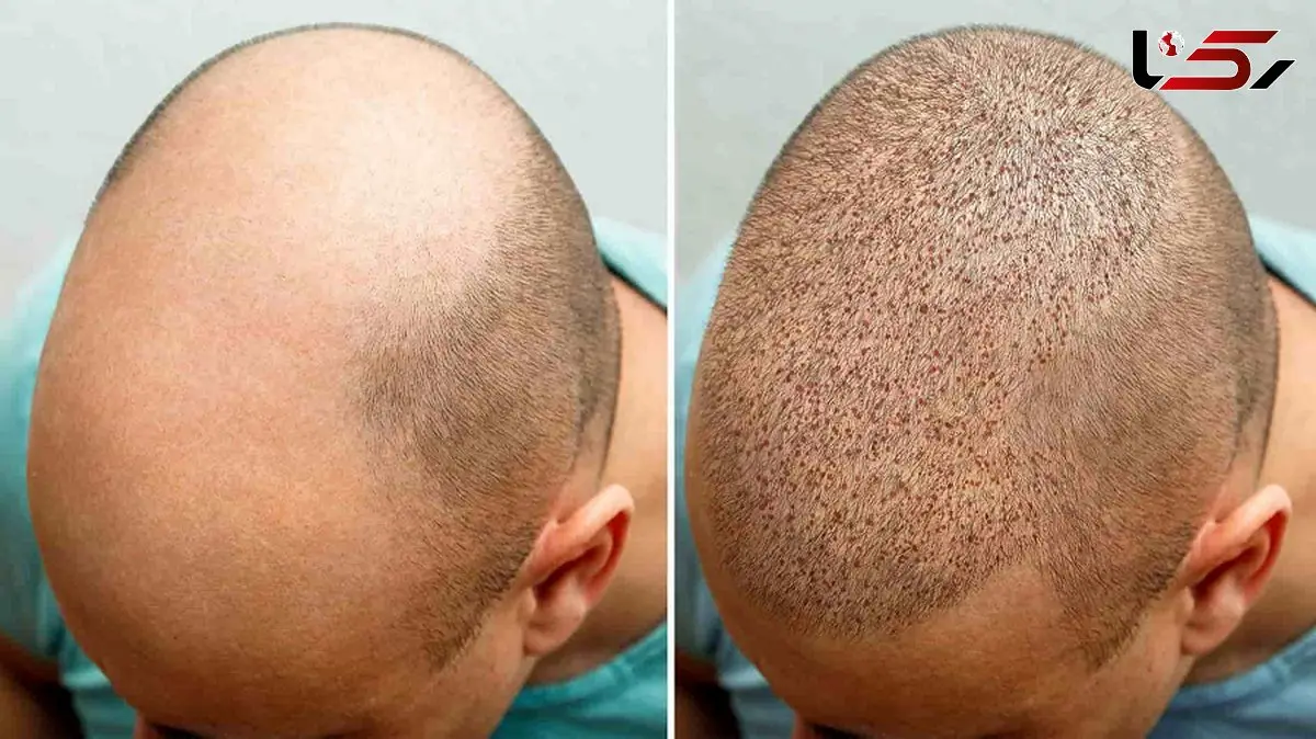 کاشت مو به روش میکروفیت و میکروگرافت دستیابی به تراکم طبیعی و خط رویش بی‌نقص