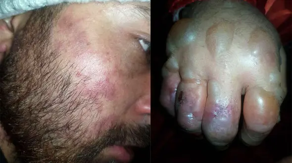 عکس های  وحشتناک از سرمازدگی کوهنورد در کلکچال 