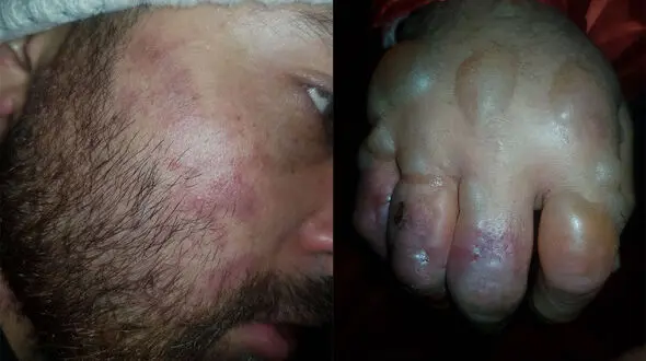 عکس های  وحشتناک از سرمازدگی کوهنورد در کلکچال 