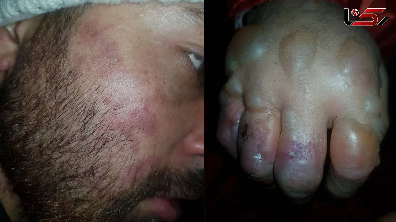 عکس های  وحشتناک از سرمازدگی کوهنورد در کلکچال 