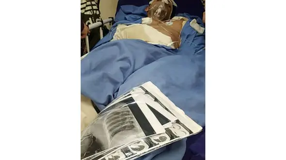 قطع شدن 2 دست و یک پای جوان تهرانی در برق گرفتگی / خواهرش از  روزهای سخت می گوید + عکس