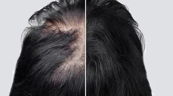 آیا امکان کاشت مو برای زنان وجود دارد ؟