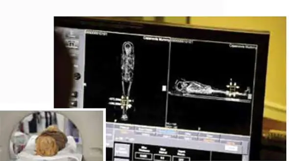 مرد 2 هزارساله قربانی سرطان+ عکس