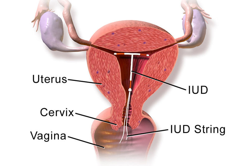 آی یو دی (IUD)