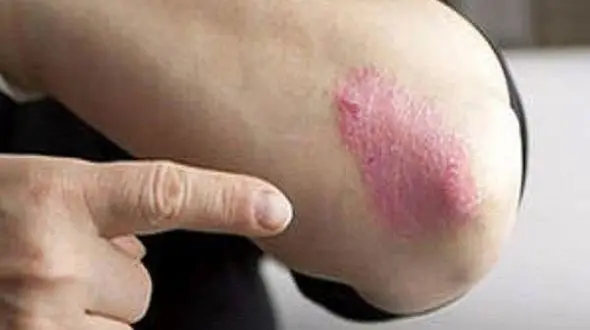 ارتباط بین درمان اگزما با کاهش بیماری آسم