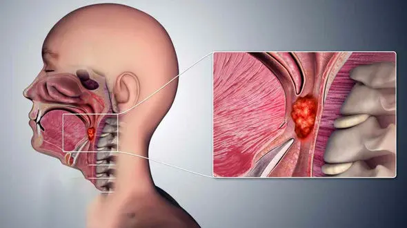 نشانه ها و درمان سرطان گلو چیست؟