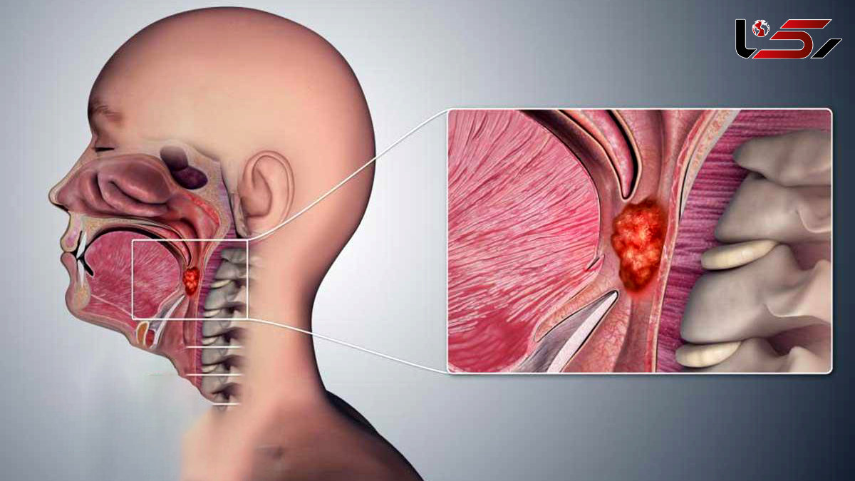 نشانه ها و درمان سرطان گلو چیست؟