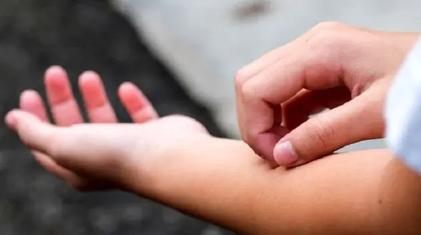 راهکارهای مقابله با خارش‌ پوست 