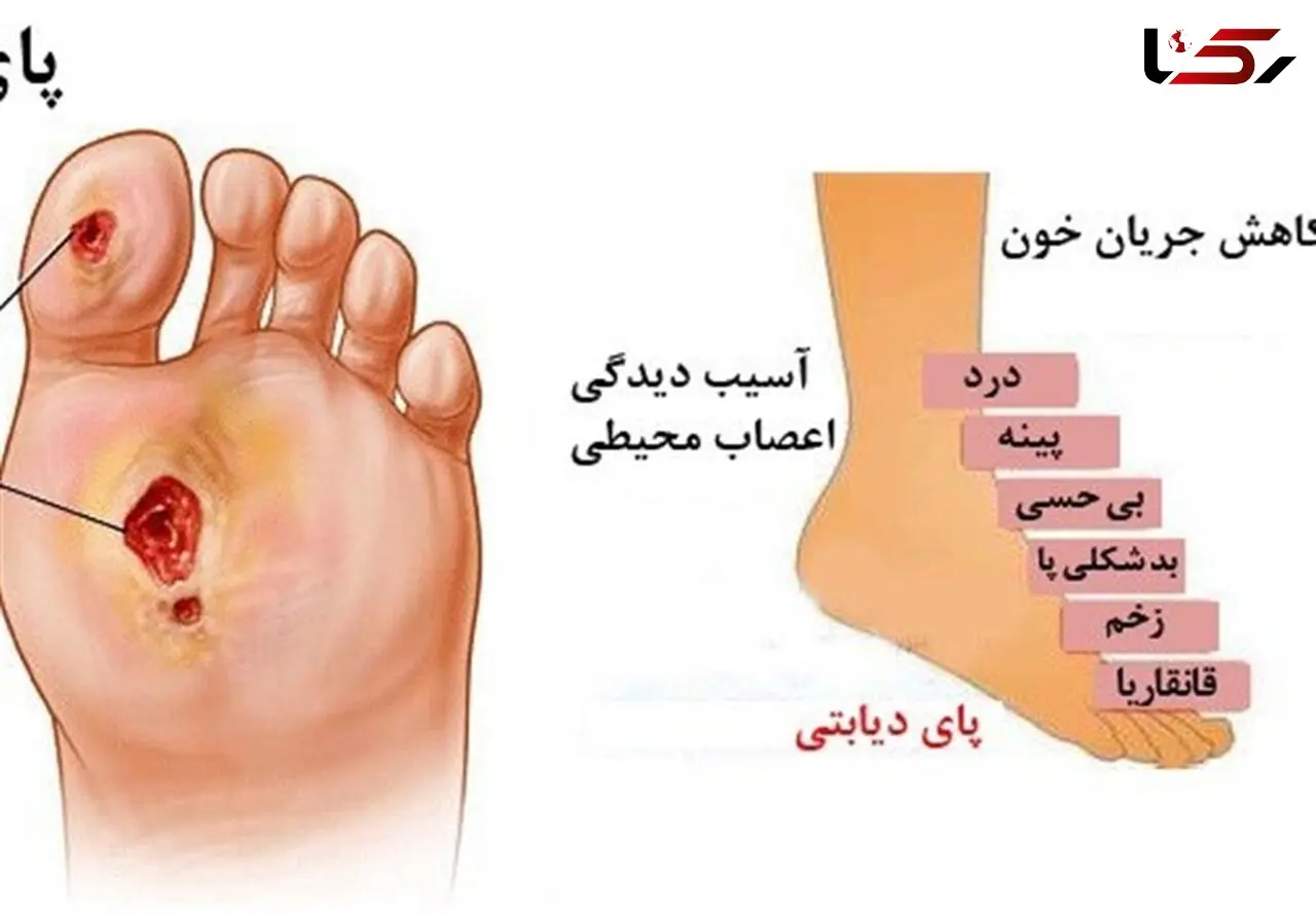 این زخم کشنده‌تر از سرطان است! + جزییات وحشتناک