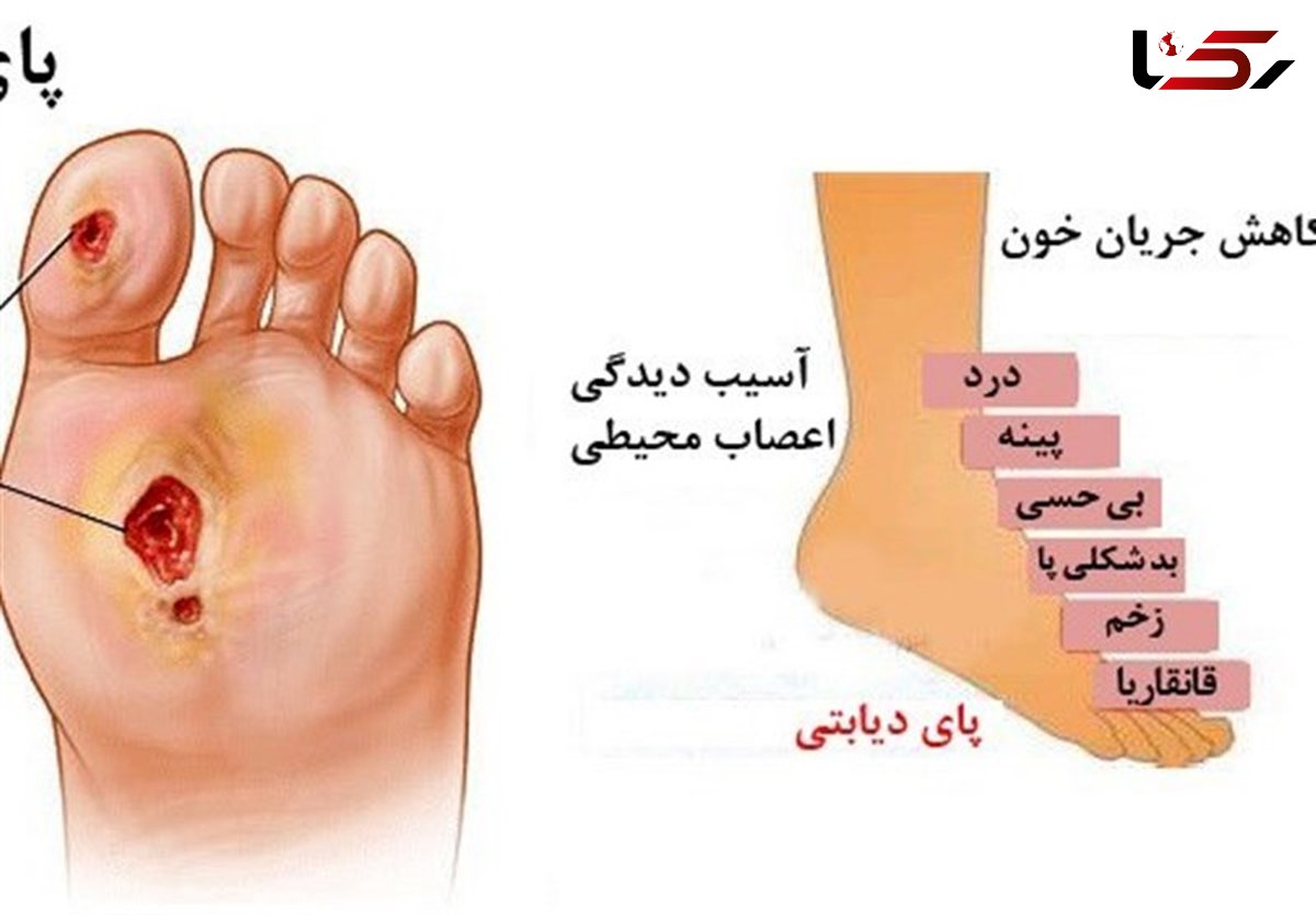 این زخم کشنده‌تر از سرطان است! + جزییات وحشتناک