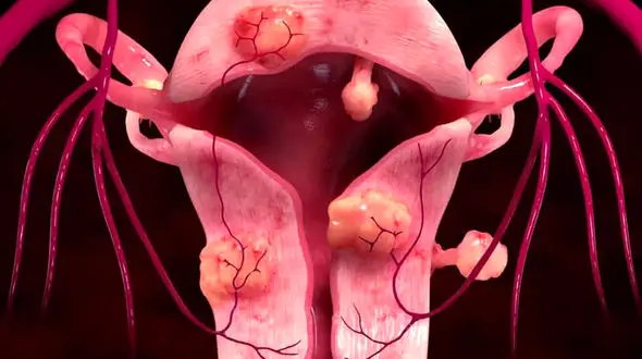 علائم فیبروم رحم + اینفوگرافیک