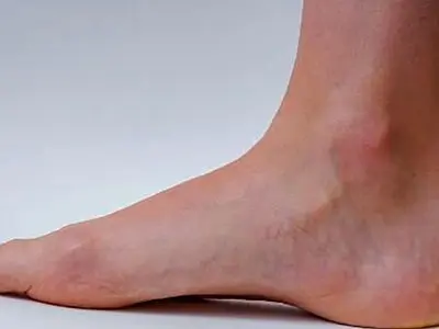 برای پیشگیری از واریس فقط یک کار را فراموش نکنید؛ بیشتر حرکت کنید!
