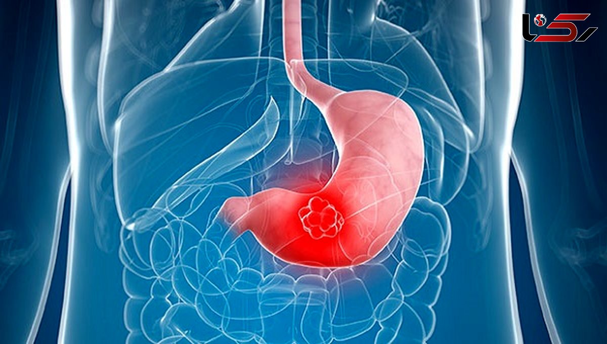 نشانه های سرطان معده که باید جدی گرفته شود