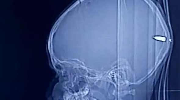 کشف یک گلوله در جمجمه کودک فلسطینی / او خوابالو شده بود + عکس