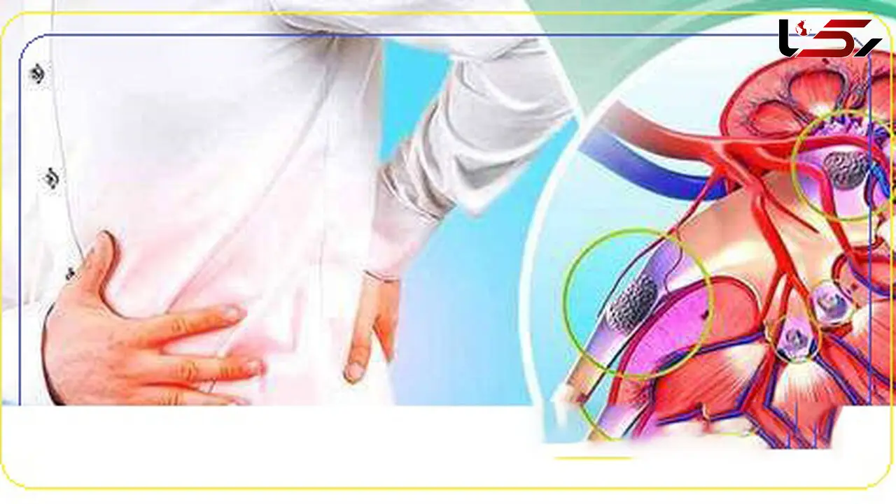 دفع سنگ کلیه بدون جراحی!