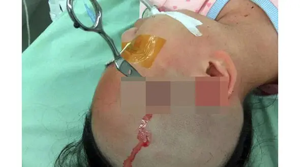 مرد بی‌رحم قیچی را در سر دختر 10 ساله‌اش فرو کرد+ عکس حادثه