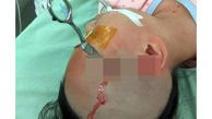مرد بی‌رحم قیچی را در سر دختر 10 ساله‌اش فرو کرد+ عکس حادثه