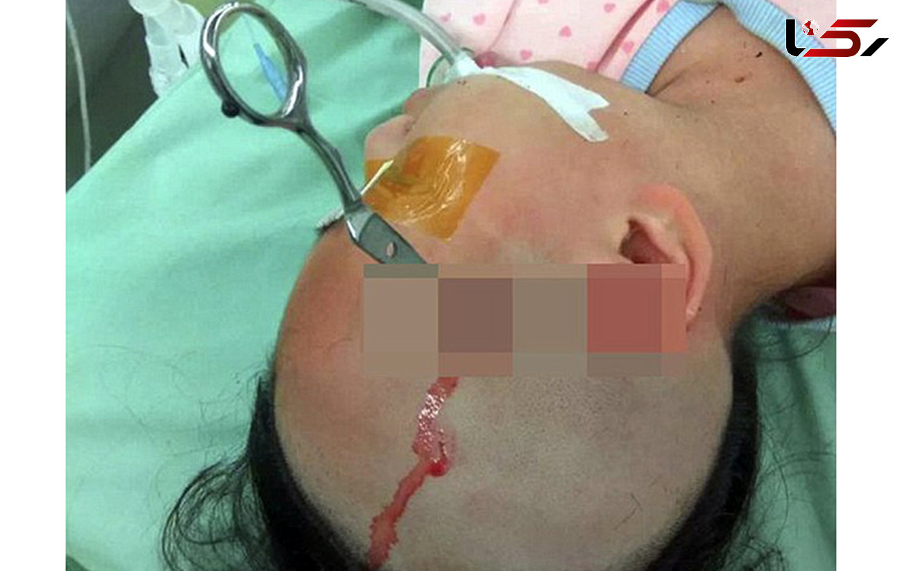 مرد بی‌رحم قیچی را در سر دختر 10 ساله‌اش فرو کرد+ عکس حادثه