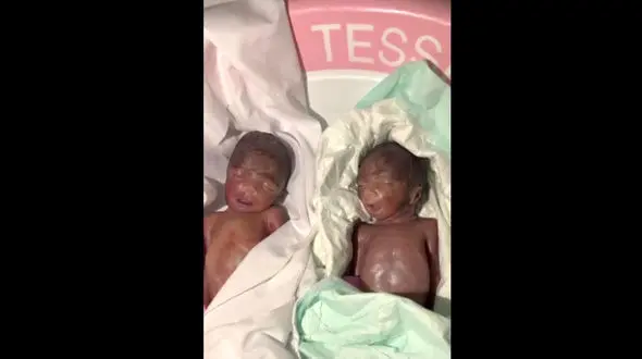 ماجرای مرگ مشکوک نوزادان دوقلو در سیستان و بلوچستان+ نوزاد نه قلب داشت نه شش که زنده بماند