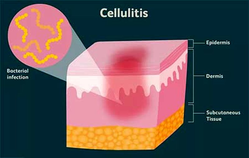 سلولیت چیست؟