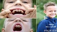 پسربچه ای با 300 دندان هیولایی!+عکس