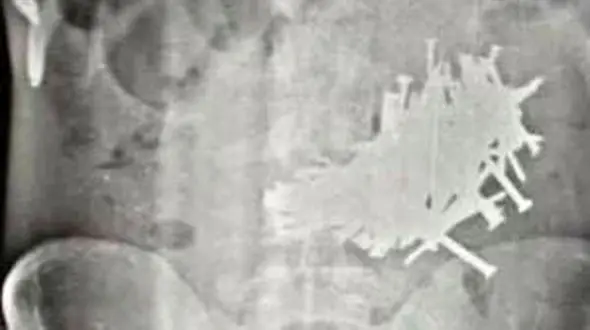 خارج کردن 116 تکه میخ از شکم مرد 43 ساله +عکس