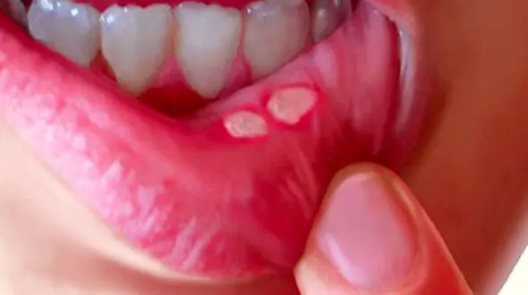 پرسش و پاسخ درباره آفت دهان