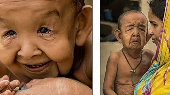 کودکی که در بچگی پیر شد + عکس